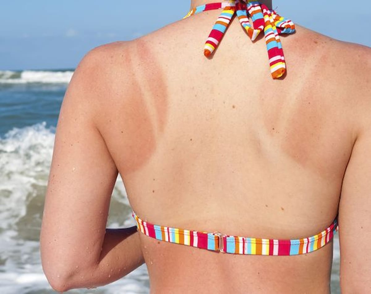  5 Home Remedies for Sunburn