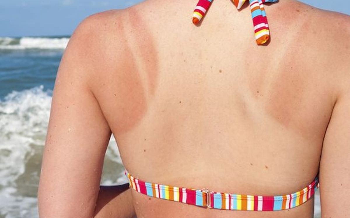 5 Home Remedies for Sunburn